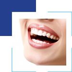 4 Reasons to Have Dental Implants