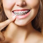 How to Protect Your Dental Braces